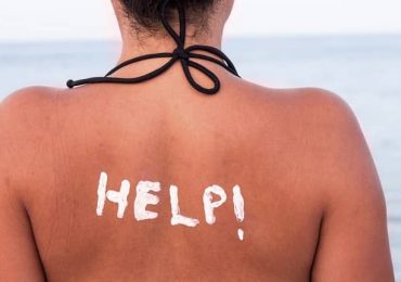 Cách chữa làn da bị cháy nắng an toàn – hiệu quả